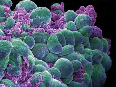 A chemical found in marijuana stops cancer from spreading. 