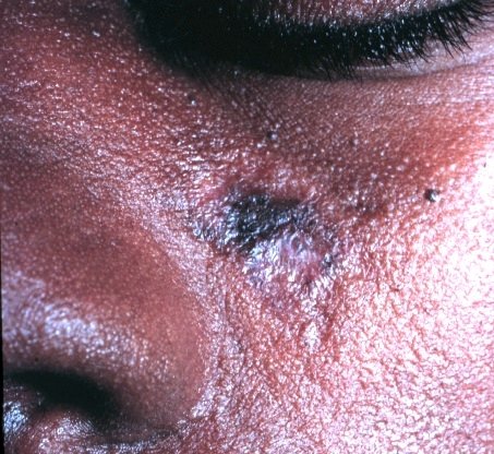 It improves the symptoms of Lupus, an autoimmune disorder. 