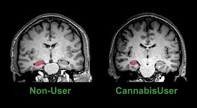 cannabis-brain
